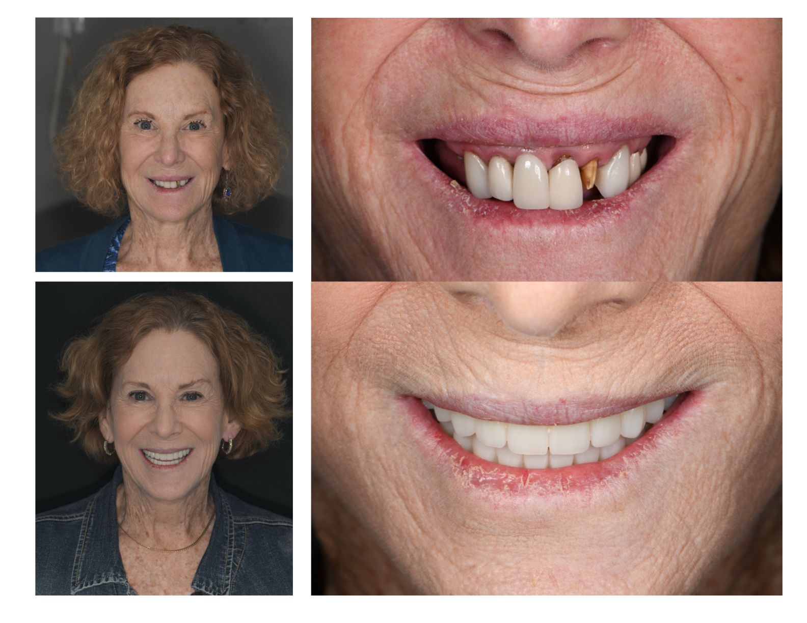 Before and after photos of a woman's smile makeover. Showing her teeth before and after dental work.