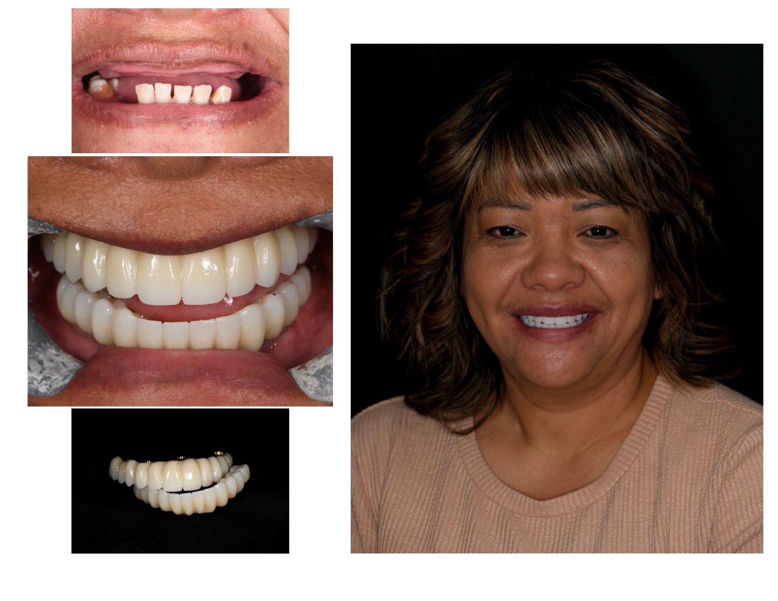 Woman smiling with new teeth; before and after dental photos on the left.