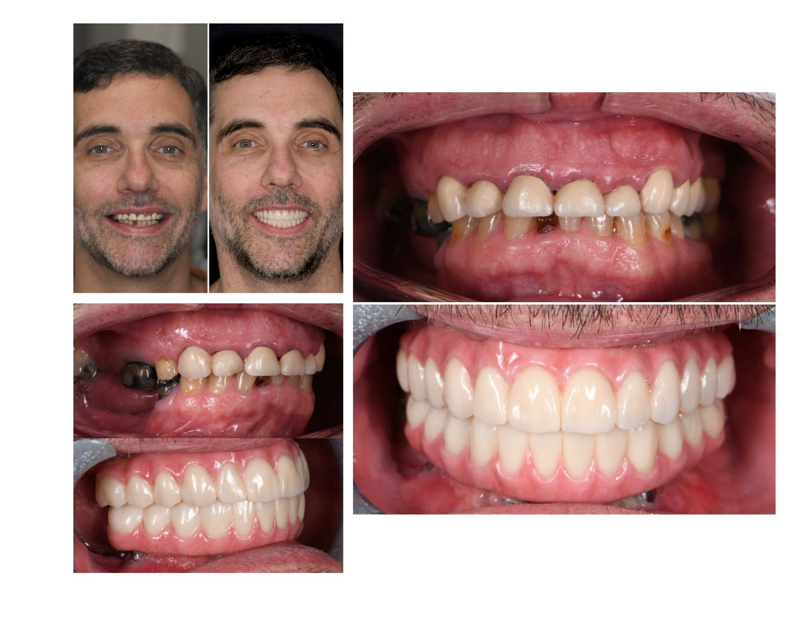 Before and after dental work: Man's smile transformation; old & new dentures compared.