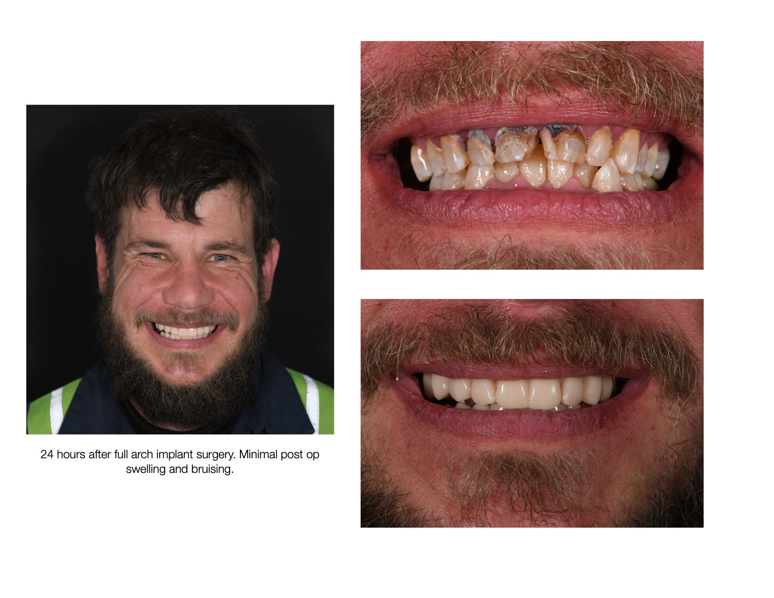 Man with damaged teeth before/after dental work; smiling with noticeable improvement.