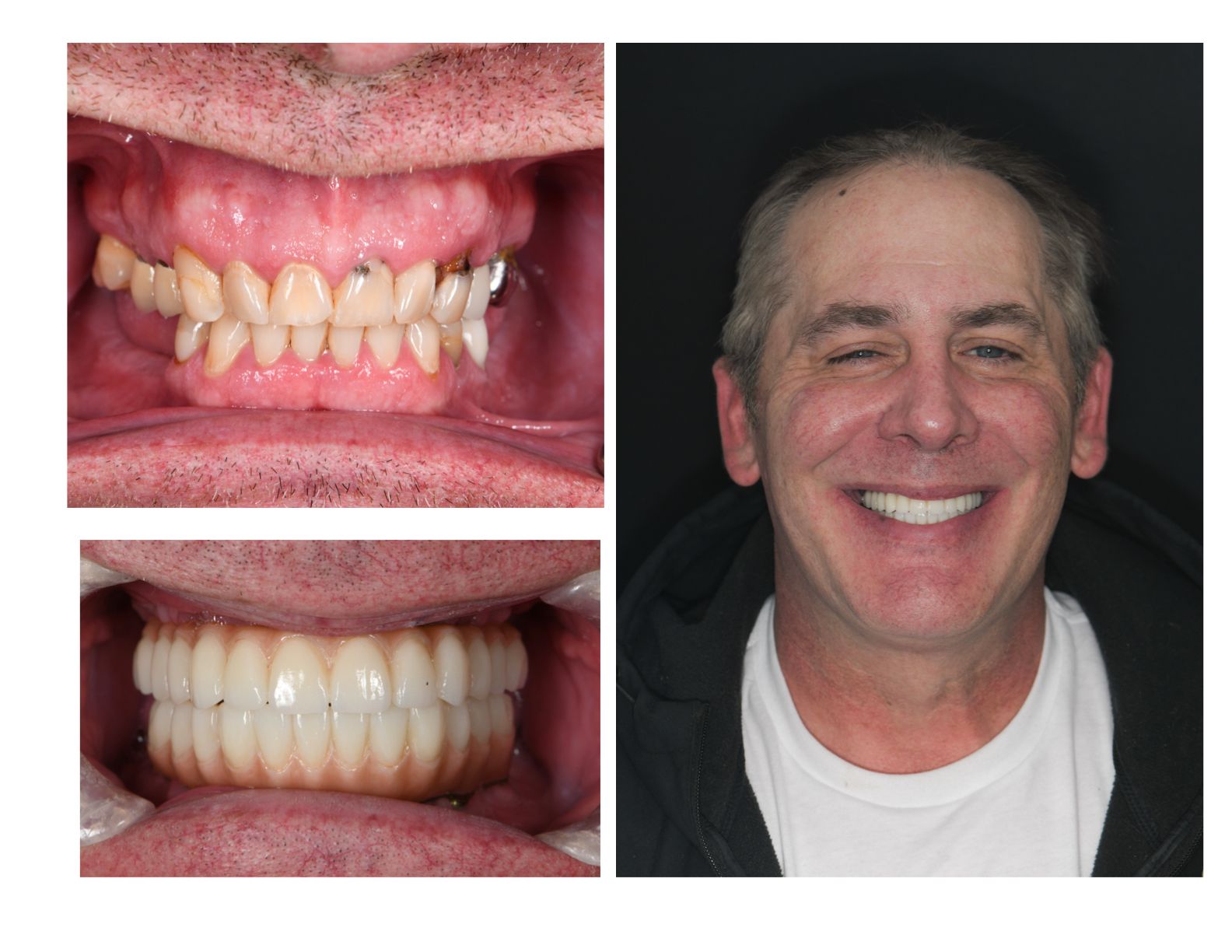Before and after of dental implants done at our top dentist near Longmont CO 80501
