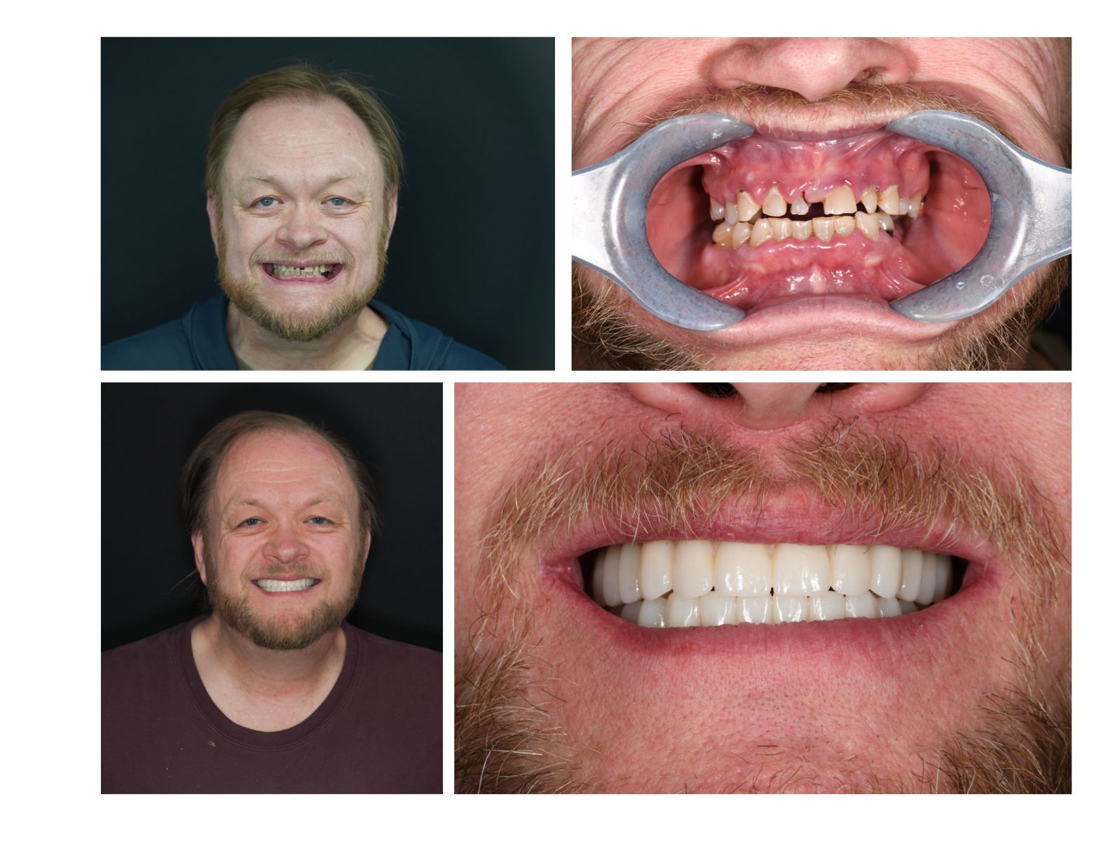 A man's teeth before and after dental work: decayed teeth, then a new bright smile.