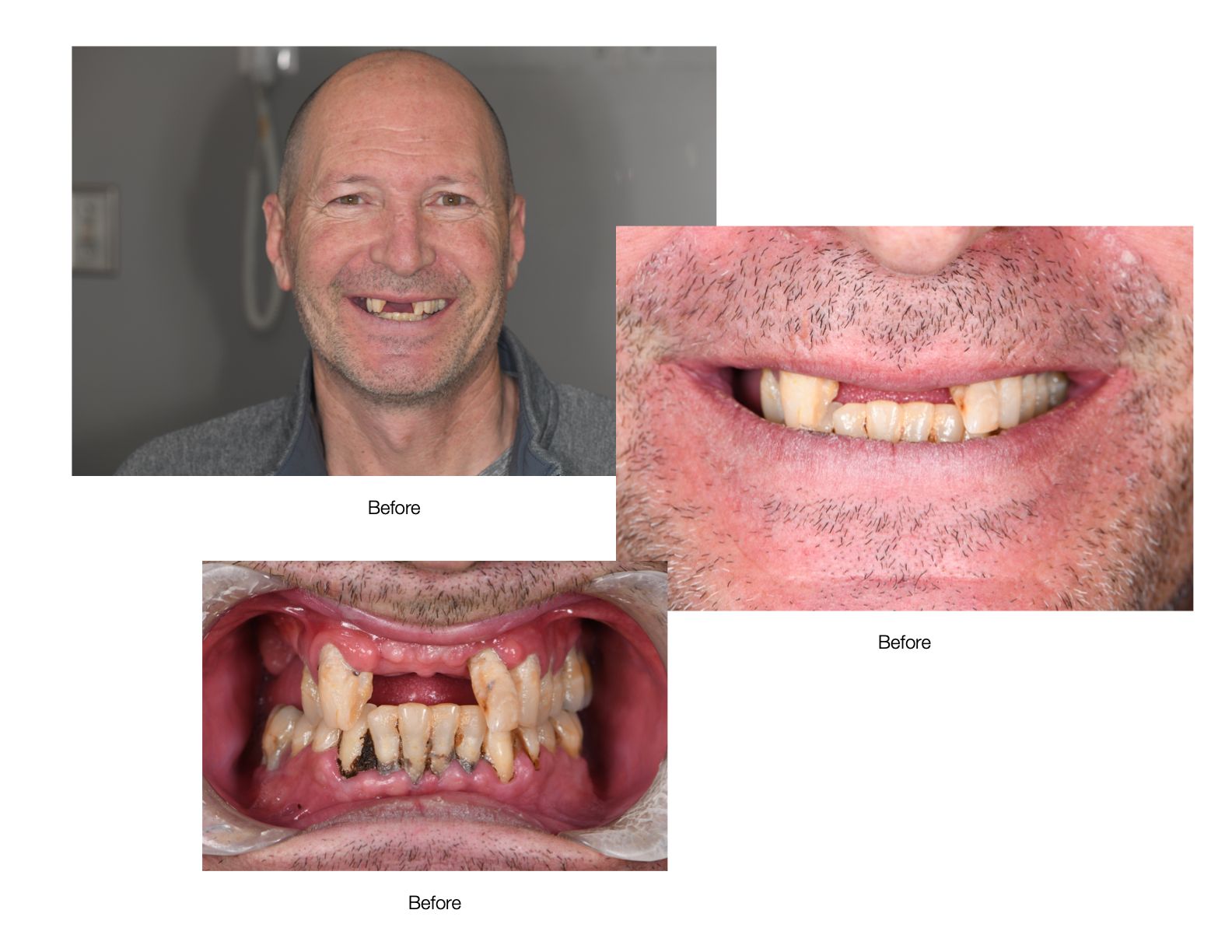 Man's teeth before and after dental work. Photos show missing and damaged teeth; after shows restored smile.