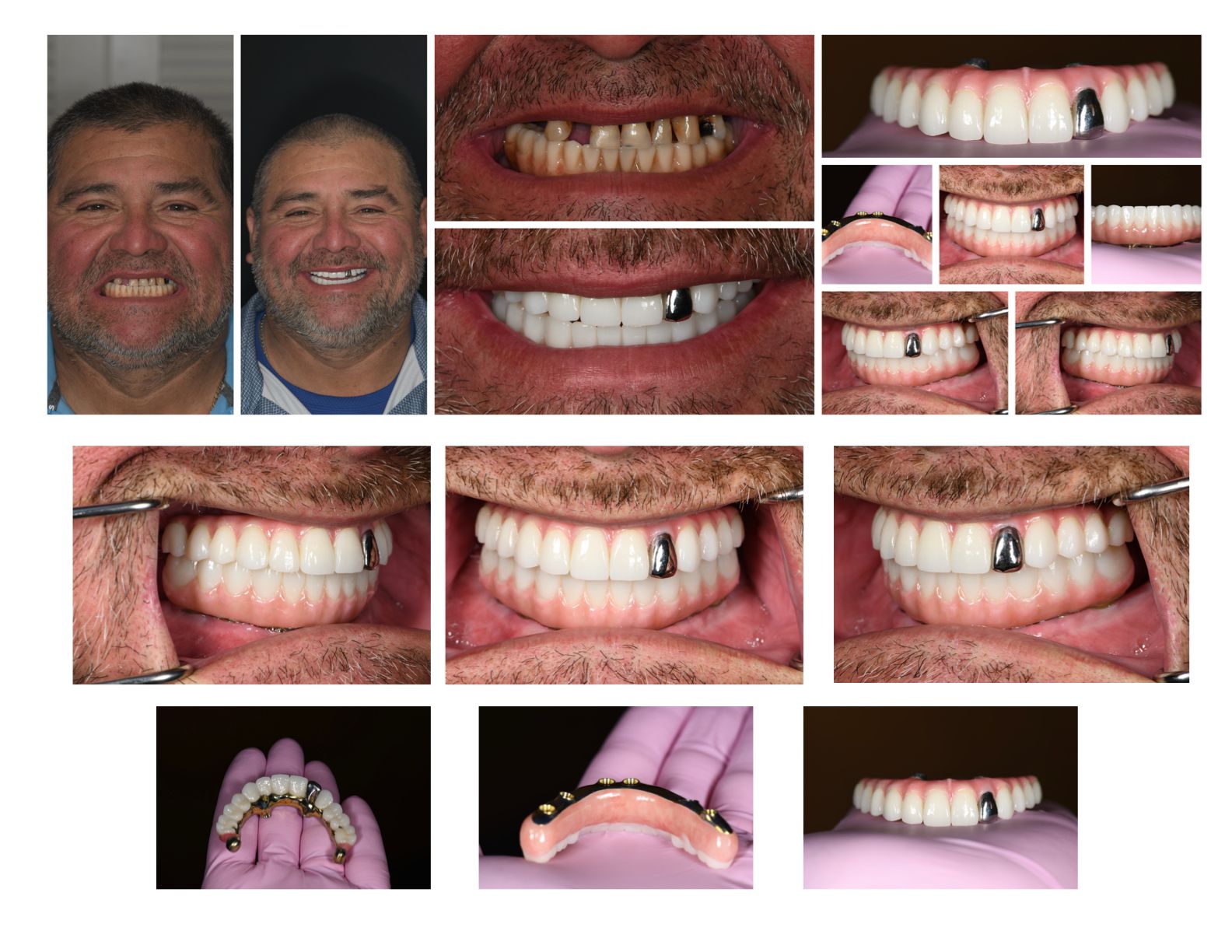 Man's teeth transformation: Before and after shots with dentures and implants, showcasing a new smile.
