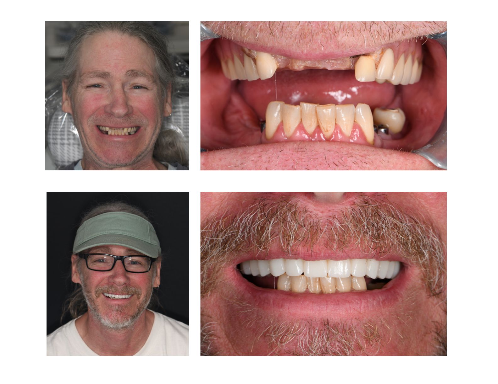Side-by-side comparison: before & after dental work, showing smile improvements for a man.