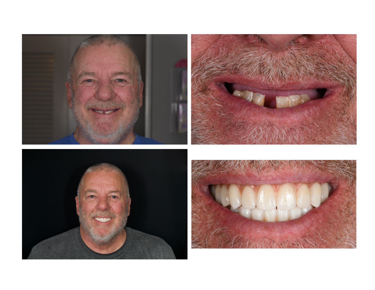 Before and after | dental implants | Dentist near longmont CO 80501