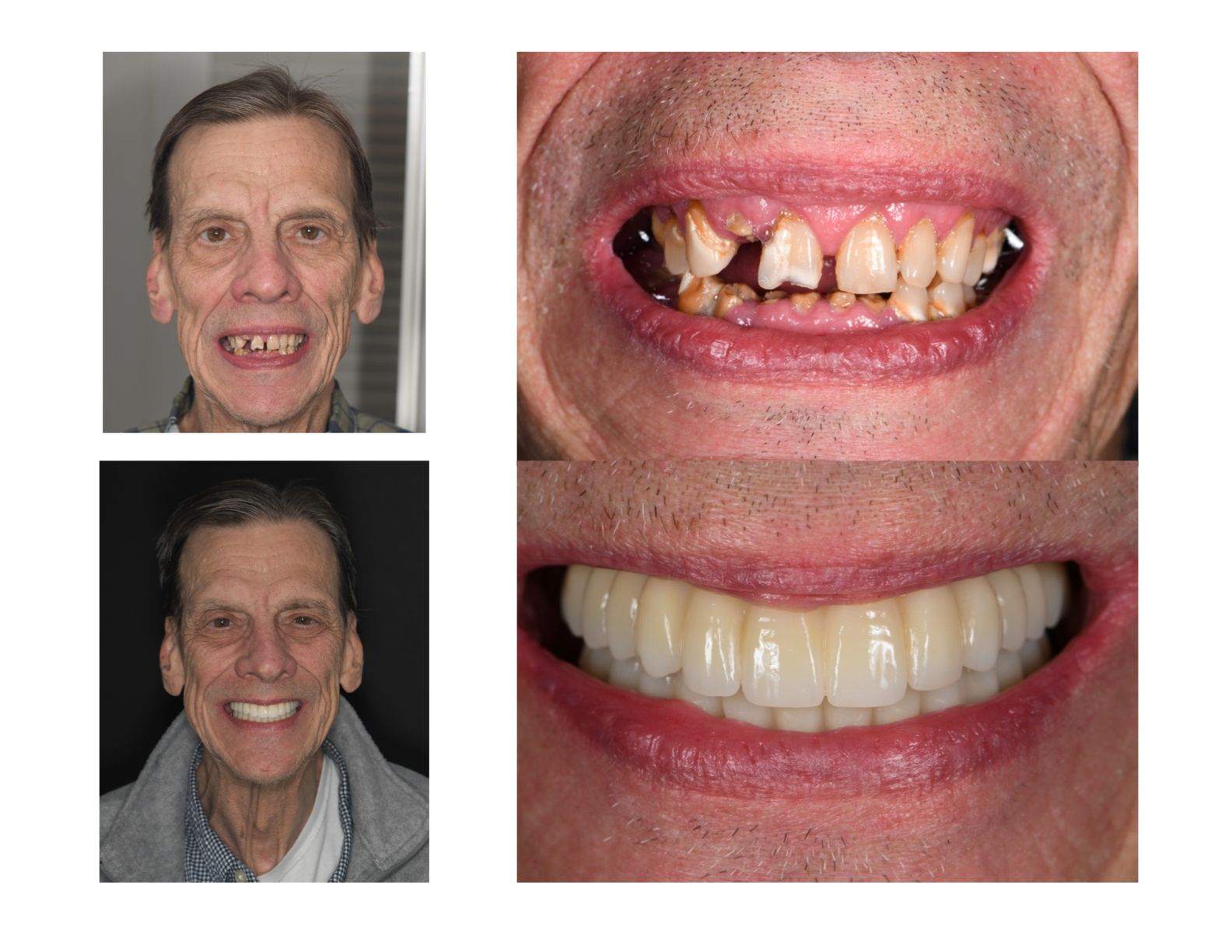 Before and after | Longmont dentist in Co 80501 | dental implants