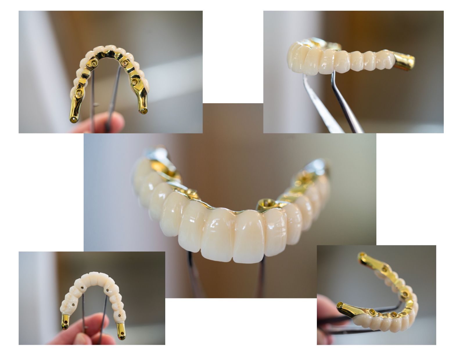 before and after dental implants done by our dentist in Longmont CO 80501