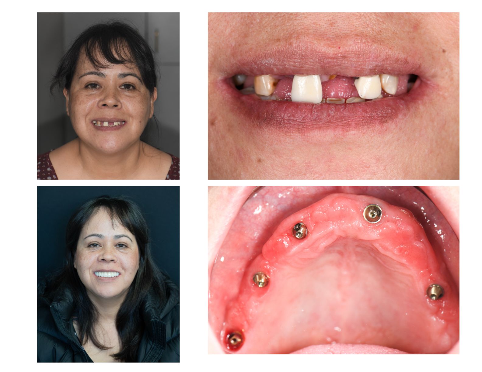 Before and after of dental implants | Longmont CO 80501 Dentist