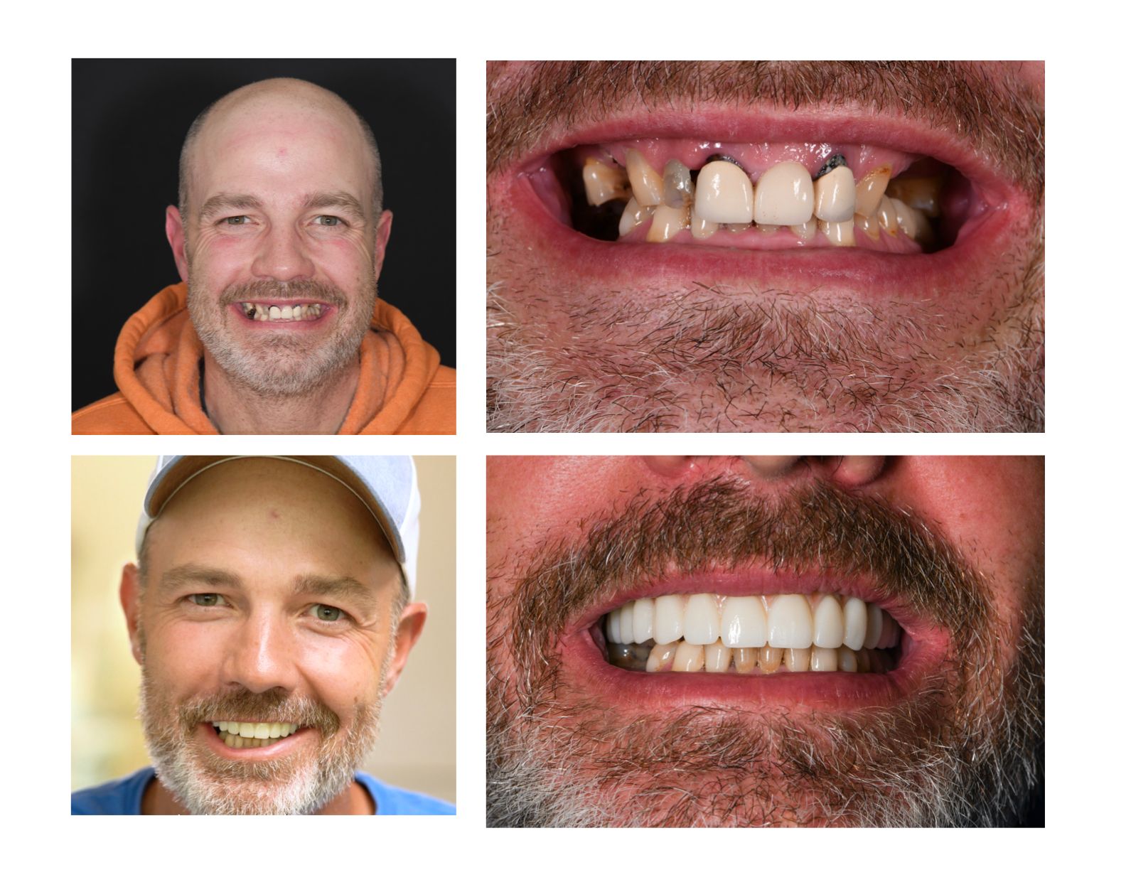 Dental implants and bonding by our Longmont Dentist