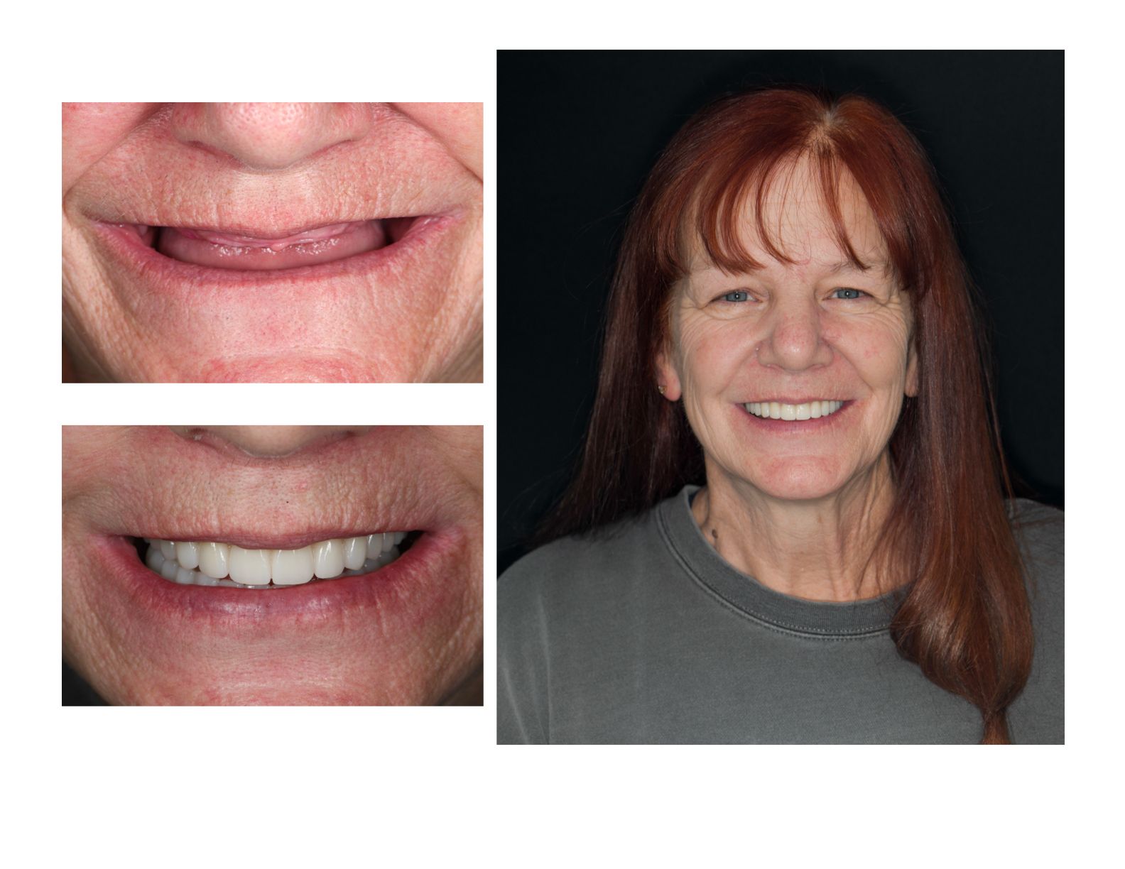 Before and after dental implants | Longmont CO 80501