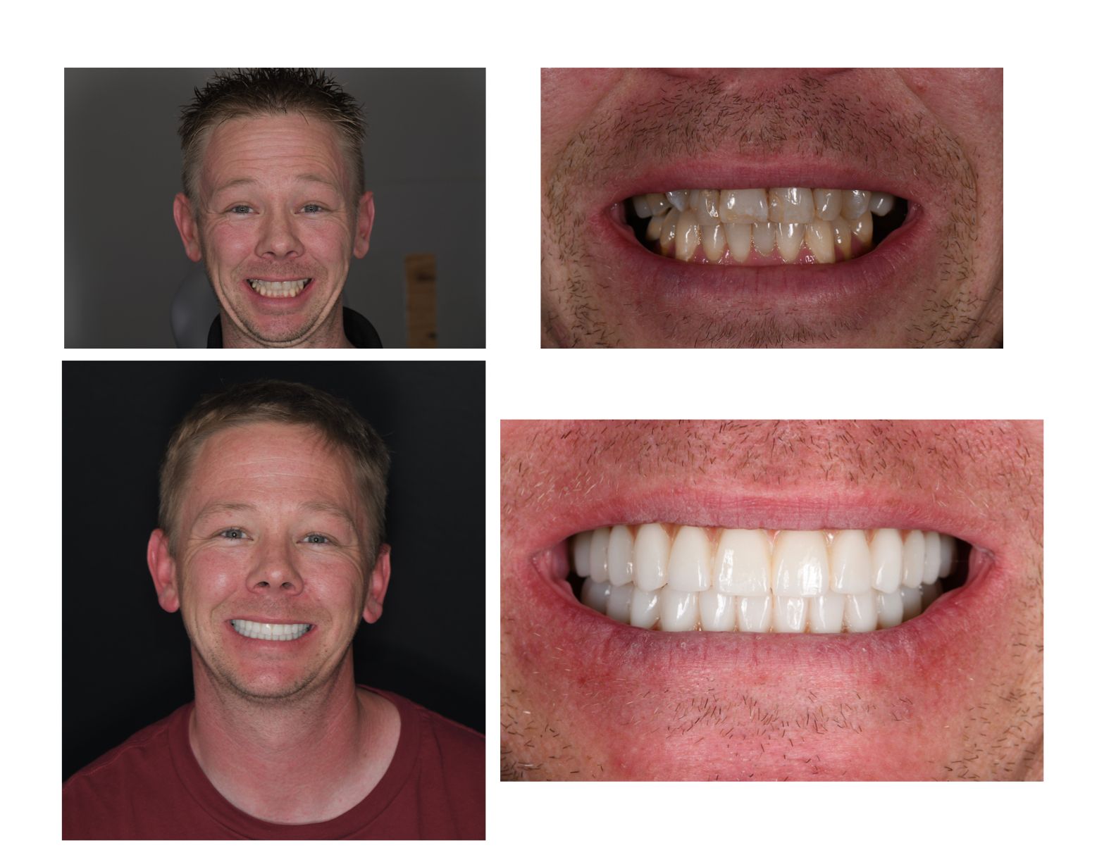 Side-by-side comparison: Man's smile with discolored teeth, then a brighter, full, white smile after dental work.
