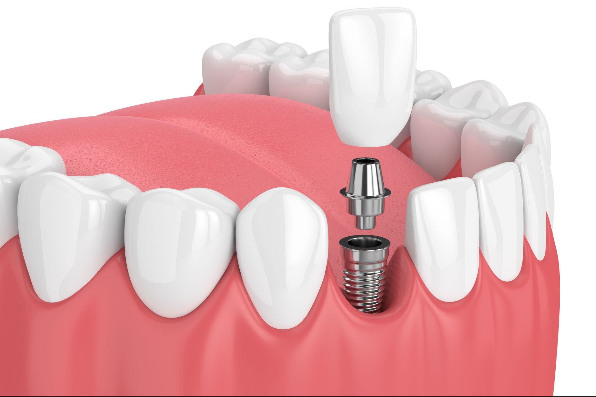 dental implants