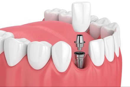 dental implants