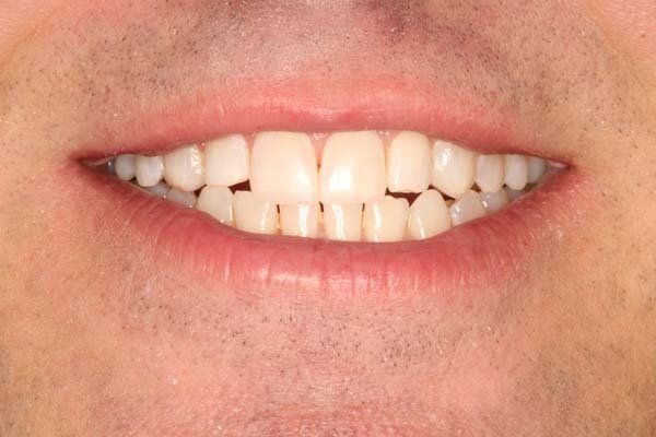 Close-up of a smiling mouth showing slightly crooked upper teeth and pink lips