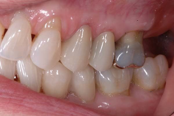 Close-up of teeth and gums with a silver dental filling on a back tooth