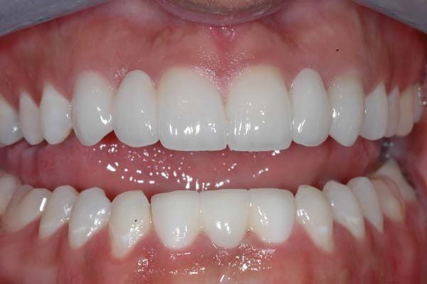 Close-up of a person’s teeth with upper and lower front teeth shown in a smile