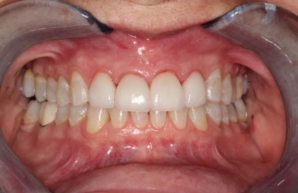 Close-up of teeth and gums with a dental retractor exposing the mouth
