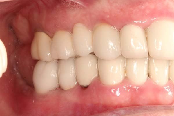 Close-up of teeth and gums, showing a side view of the mouth