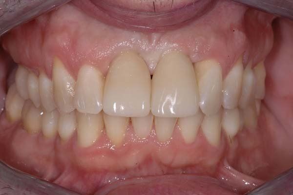 Close-up of a person's teeth and gums, showing an orthodontic bite alignment with the lips retracted.