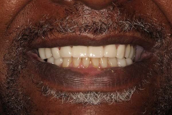 Close-up of a smiling mouth with white teeth and a dark mustache