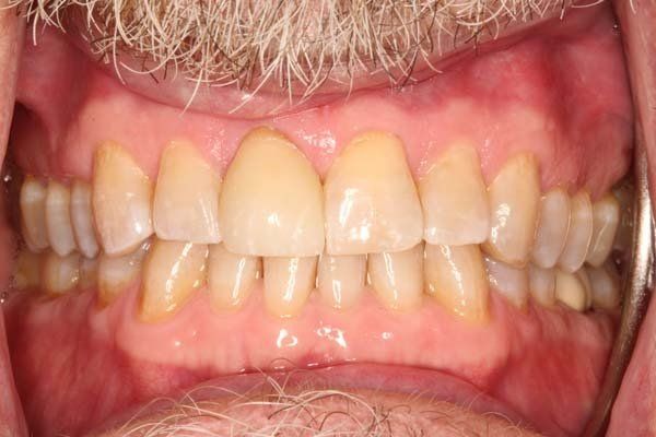 Close-up of open mouth showing yellowed, crowded teeth and gums