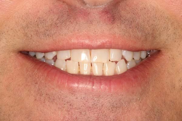 Close-up of a smiling mouth with visible teeth and light facial stubble