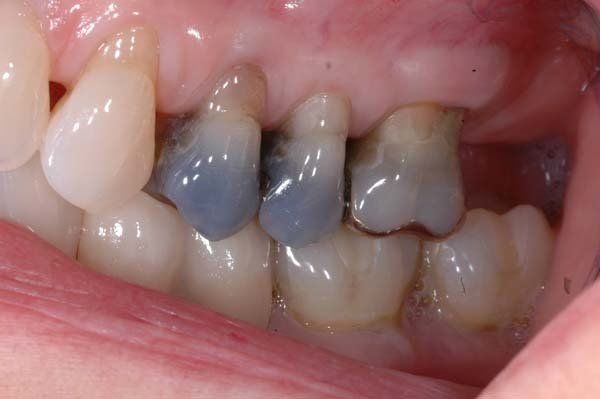 Close-up of teeth with two blue-gray metal dental fillings on upper molars