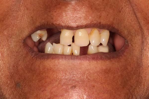 Close-up of a mouth with missing and misaligned teeth showing a dental gap