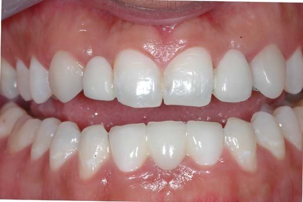 Close-up of a smiling mouth showing white upper and lower teeth