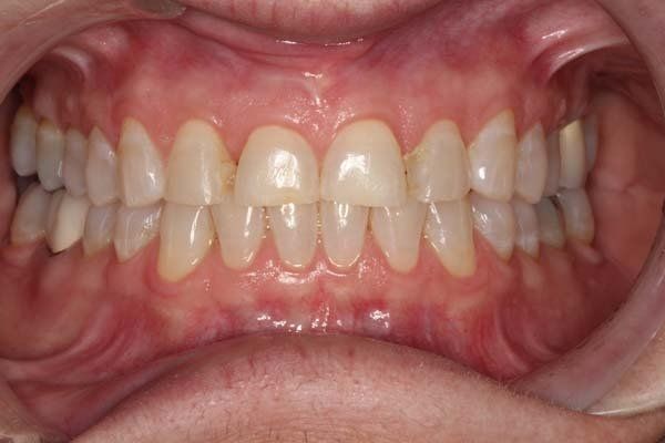 Close-up of a person's teeth and gums with a slight gap between the upper front teeth.