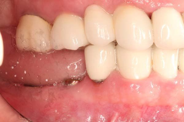 Close-up of upper and lower teeth with a small white dental appliance against the lower gum