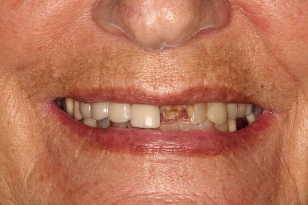 Close-up of a smiling mouth with missing and crooked front teeth