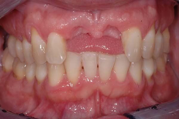 Close-up of teeth and gums with a gap from a missing upper front tooth