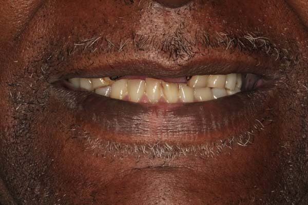 Close-up of a smiling mouth with visible teeth and a mustache
