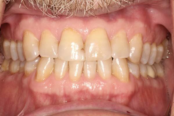 Close-up of teeth and gums with noticeable crowding and yellow discoloration