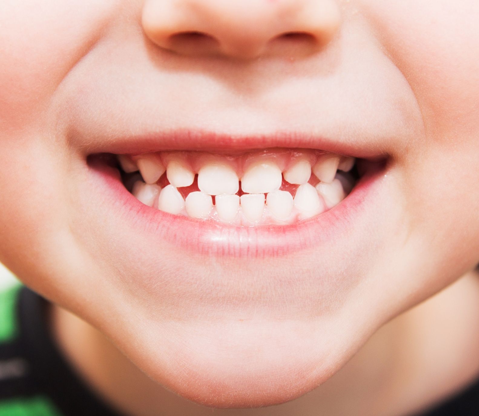Kiddsmiles Pediatric Dentistry Treatments- Sedation, Floral Park, white plains, westchester, manhasset, merrick, holbrook, syosset, port jefferson station, north babylon, nassau county, suffolk county
