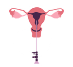 Ícone Histeroscopia