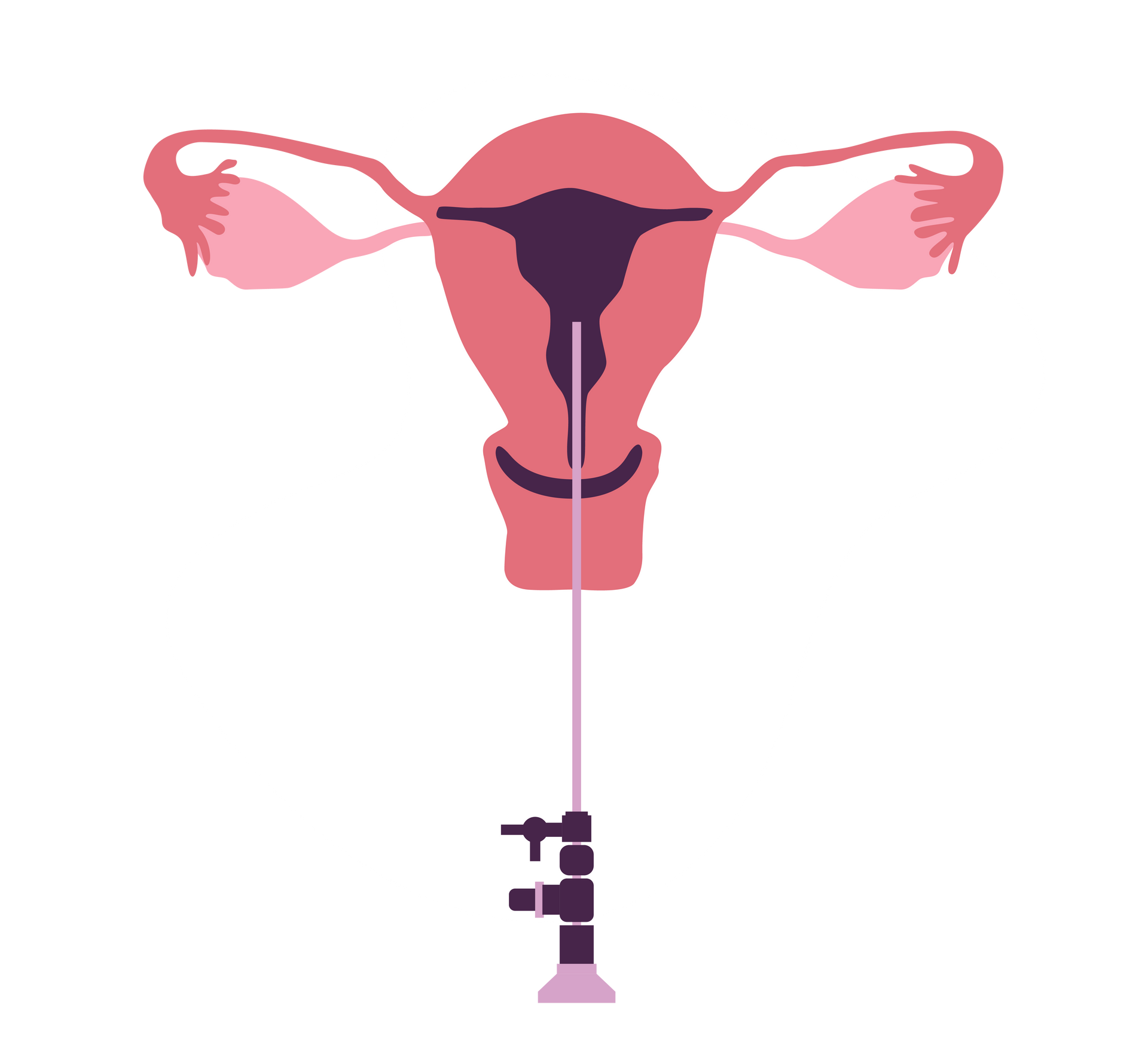 Ícone histeroscopia