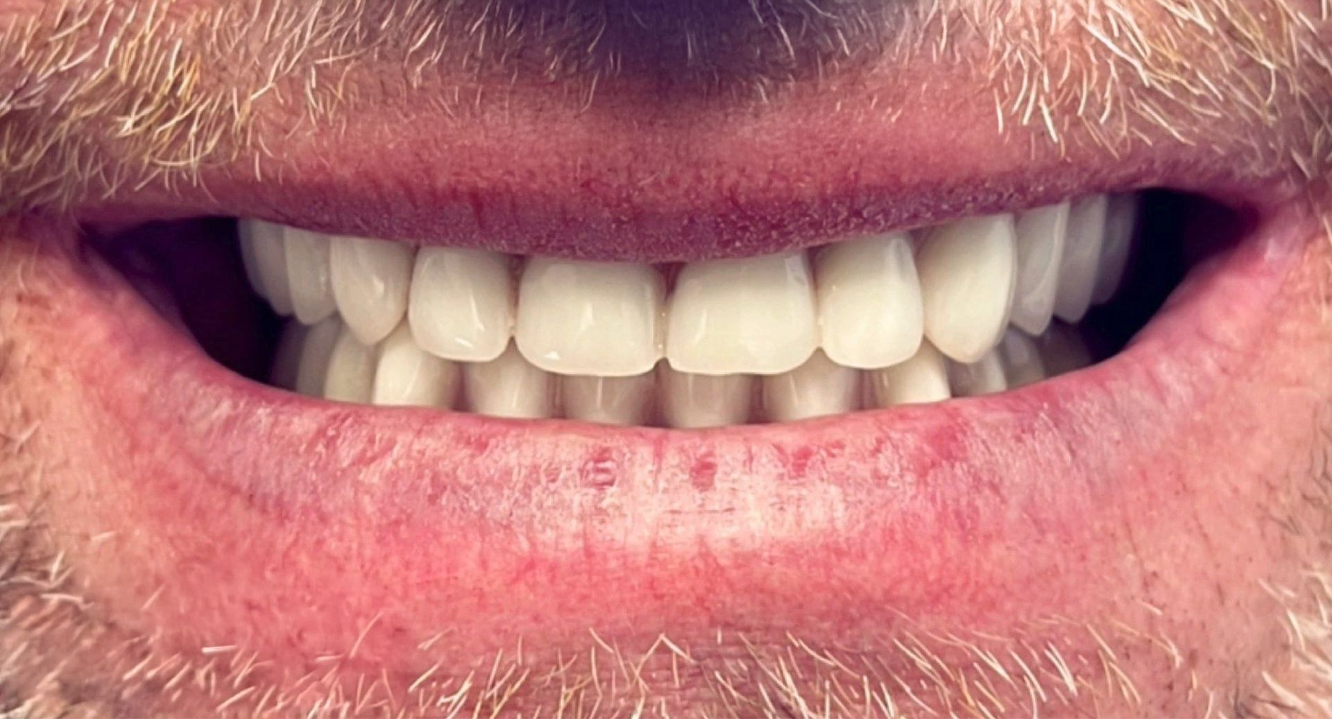 Angel Denture Clinic - Before and After Gallery