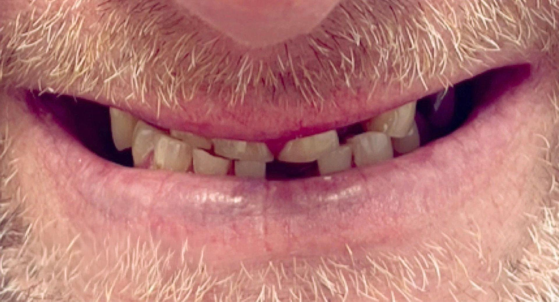Angel Denture Clinic - Before and After Gallery