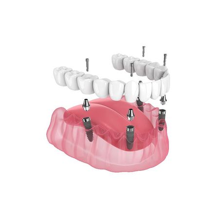 Exploded dental implant model with pink gum, white teeth, and metal posts showing a prosthetic arch assembly