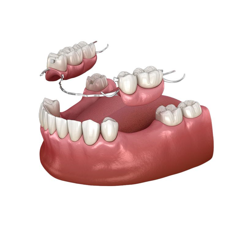 Dental arch with several removable partial dentures shown in red and white against a white background