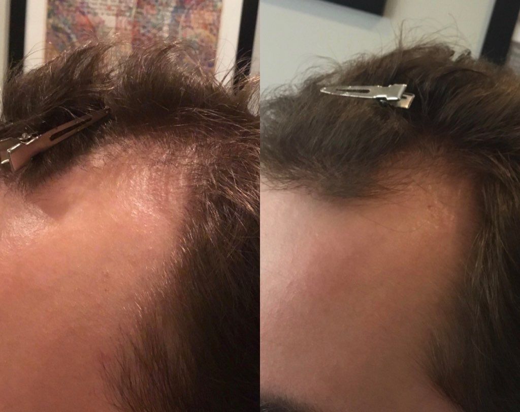 A before and after picture of a man 's hair with a clip in it.