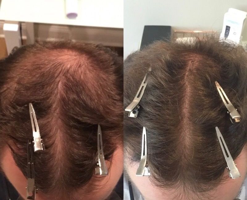 A before and after picture of a person 's hair with hair clips.