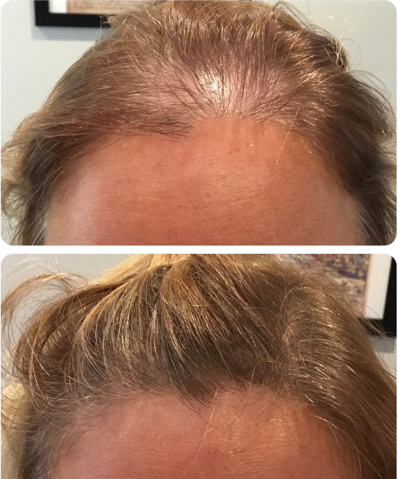 A before and after photo of a woman 's hair growth.