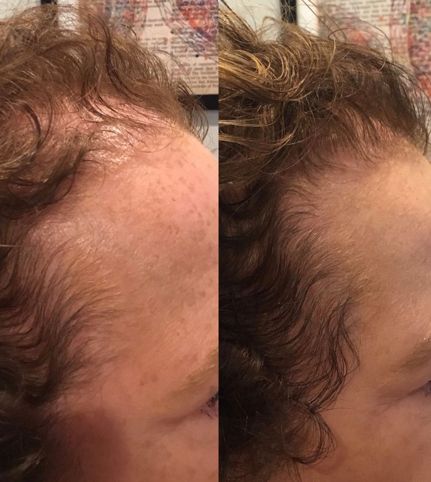 A before and after picture of a person 's hair growth.