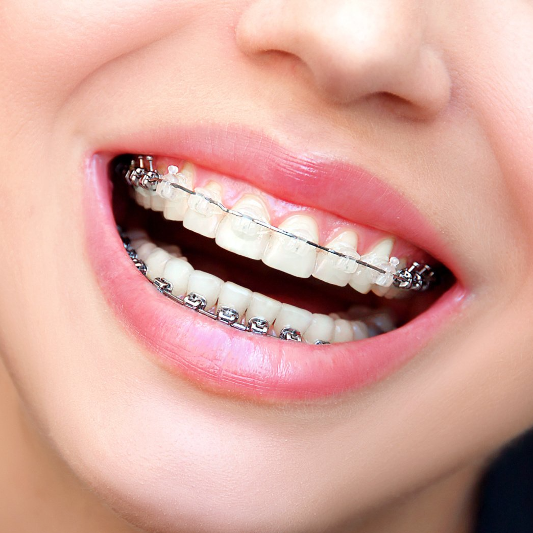 Close Up of Braces