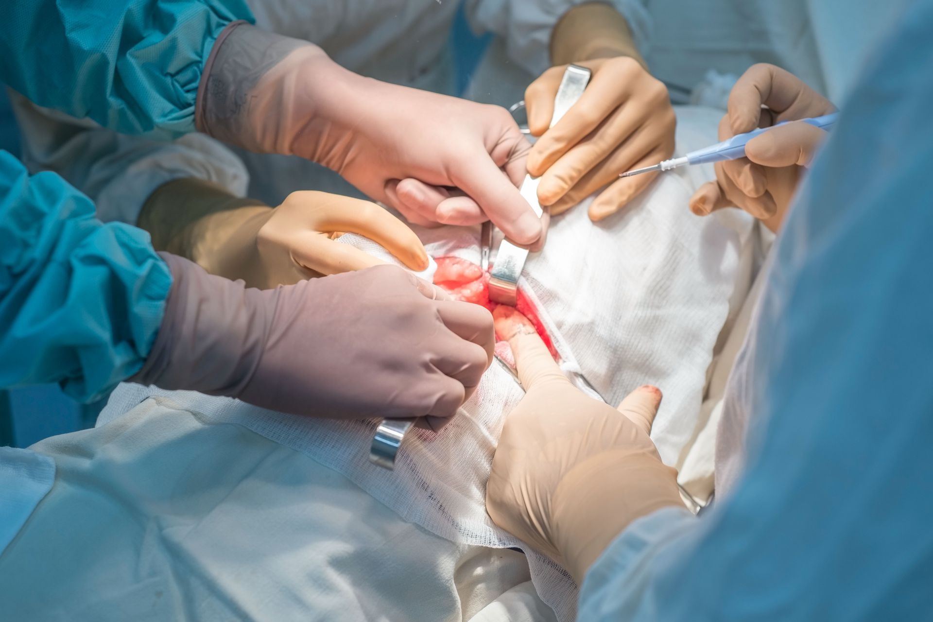 O que é ureterorrenolitotripsia? O que é ureterorrenolitotripsia