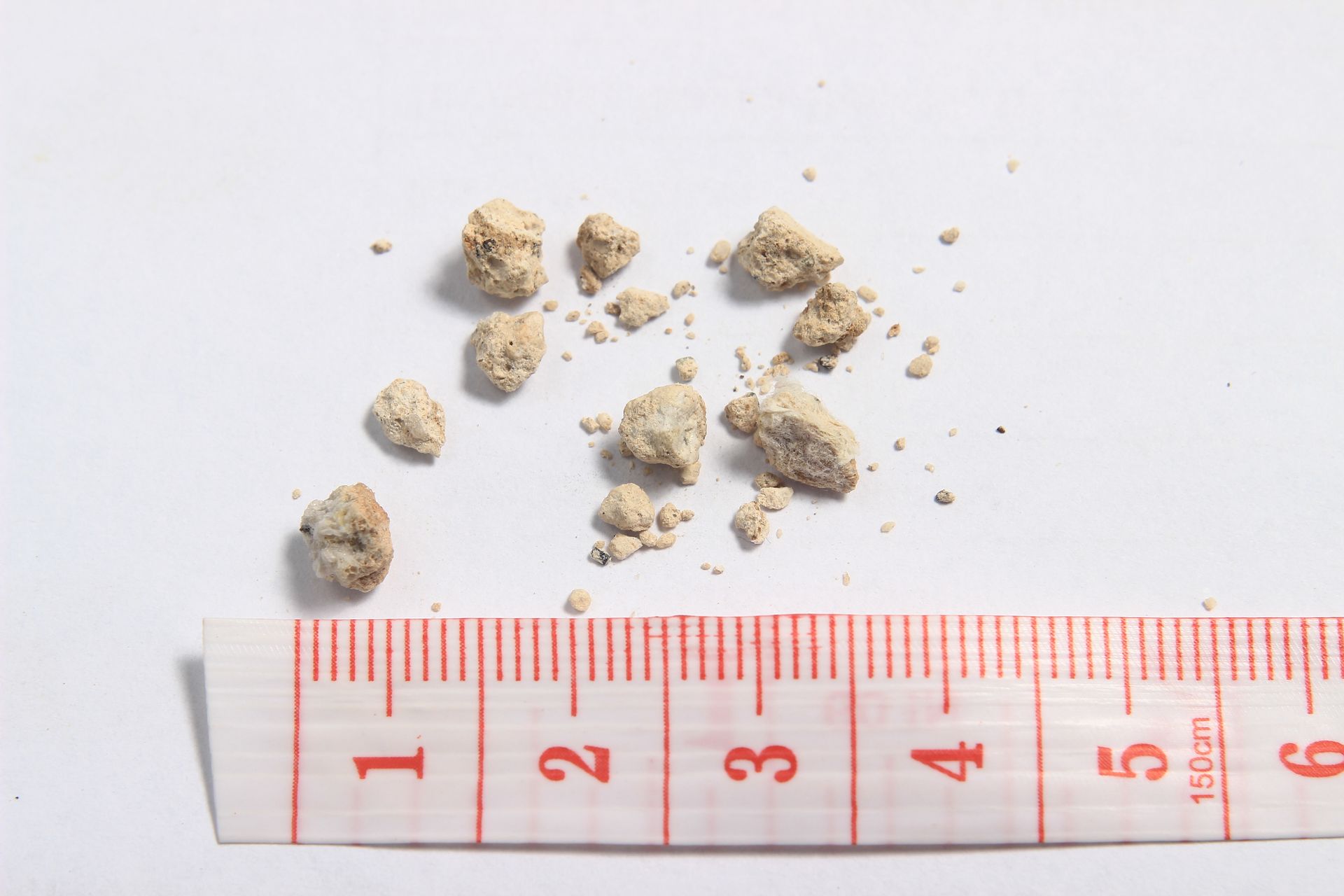 Quais as vantagens da ureterorrenolitotripsia? quais as vantagens da ureterorrenolitotripsia